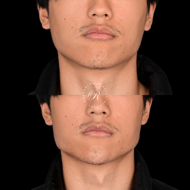 Non-surgical ChinJaw Augmentation RPS Before & After.zip - 45