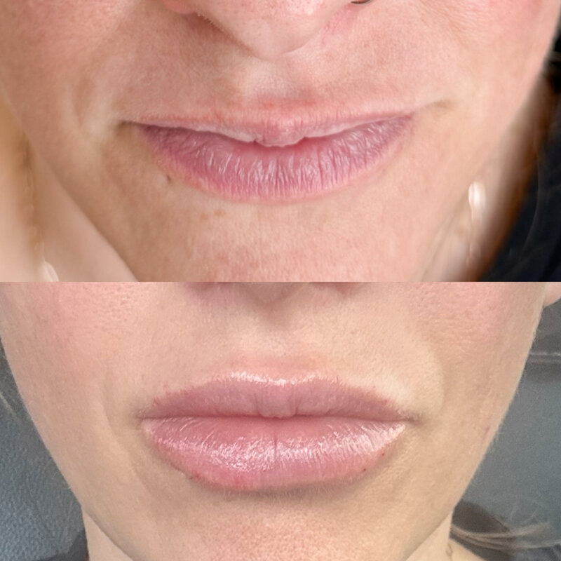Lip Filler in Rockwall TX