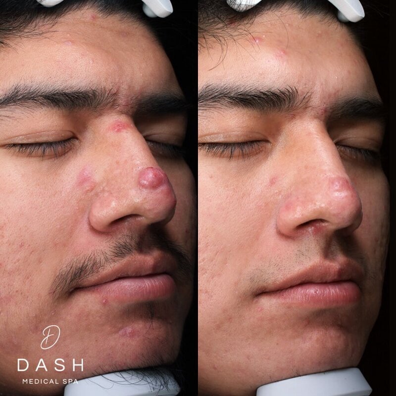 Neo Elite® - Acne (8)