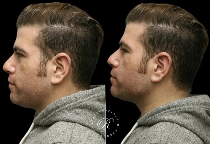 Non-surgical ChinJaw Augmentation RPS Before & After.zip - 7