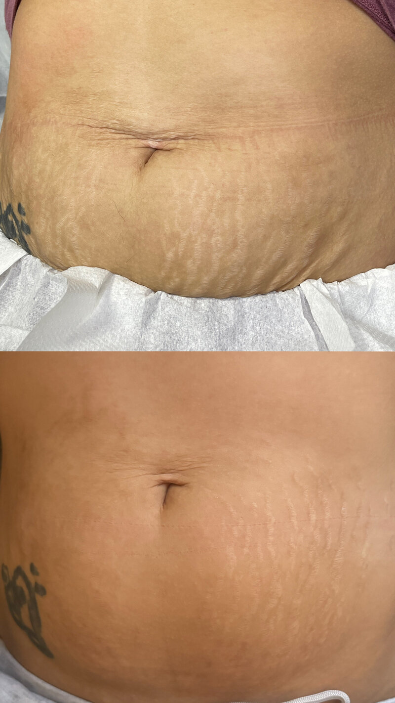 This image shows a before and after photo after the client received stretch mark camouflage by A Look That Lasts permanent cosmetics in Sacramento, CA by artist Shaunna Nunes