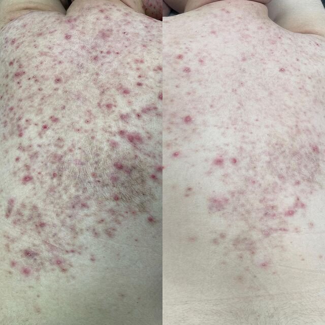 Acne by Aerolase (19)