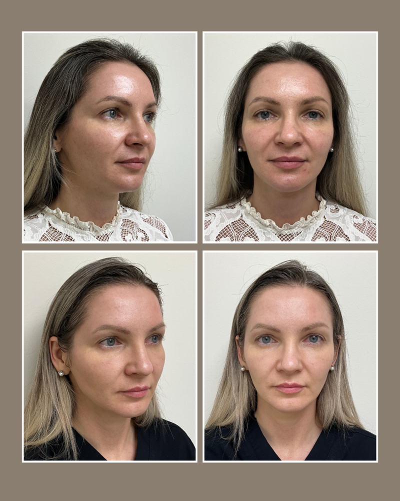 Lasers - Glösense Dermatology and Aesthetics, Miami