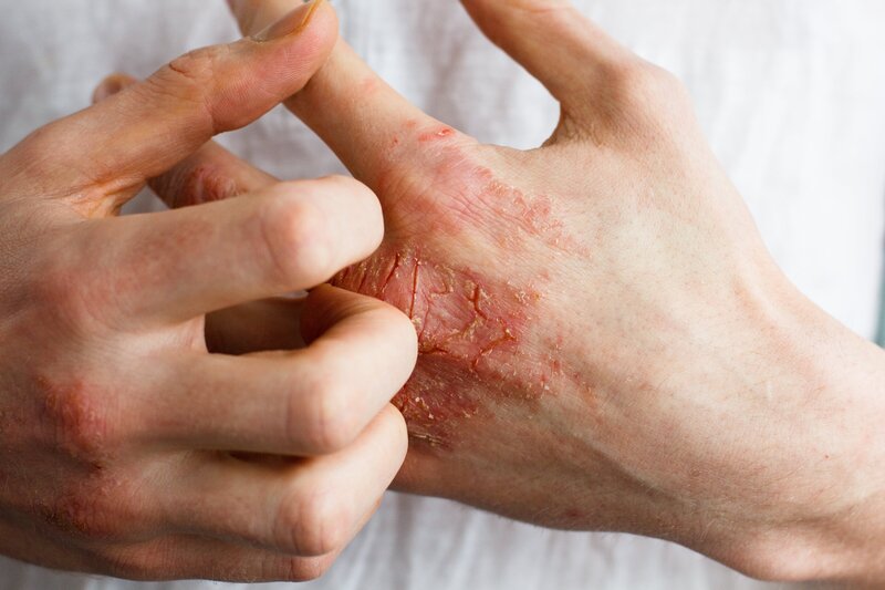 irritated hands scratching eczema patches