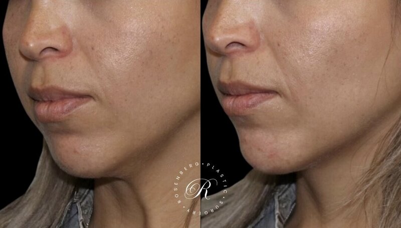 Non-surgical ChinJaw Augmentation RPS Before & After.zip - 3