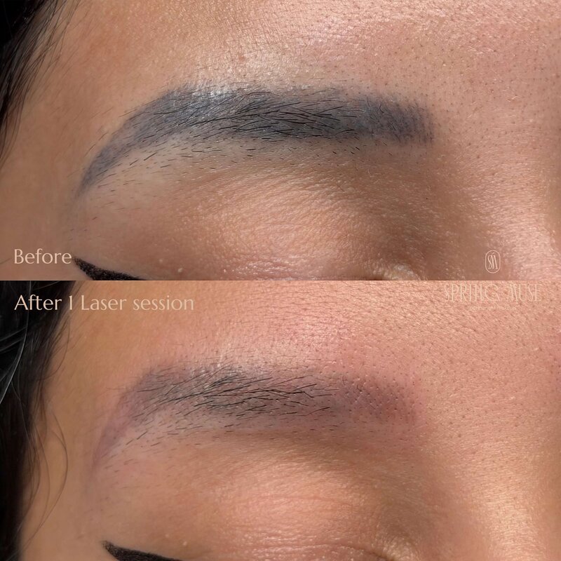 Laser Eyebrows Removal New York
