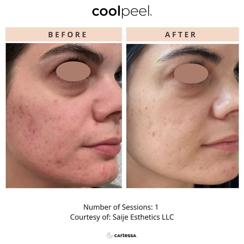 CoolPeel before and after photo face