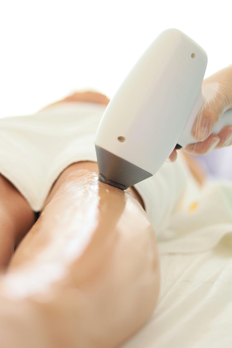 femme qui se fait épilation définitive laser