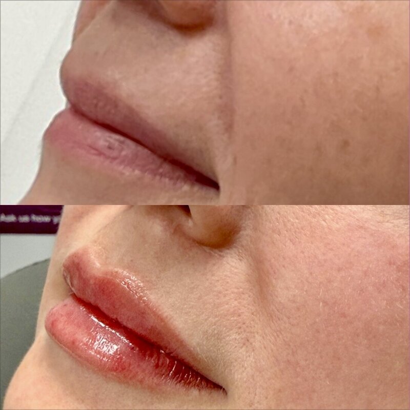 Dermal fillers provide a versatile, age-appropriate solution for those looking to restore or enhance features in their face. By adding balance and restoring lost facial volume, these cosmetic injectables allow individuals of all ages the chance to look their best with minimal effort. Whatever your skin concern, our experts at Bellezza Moderna Aesthetics can help. We offer safe, effective dermal filler treatments to clients in the Lakes Region of New Hampshire.