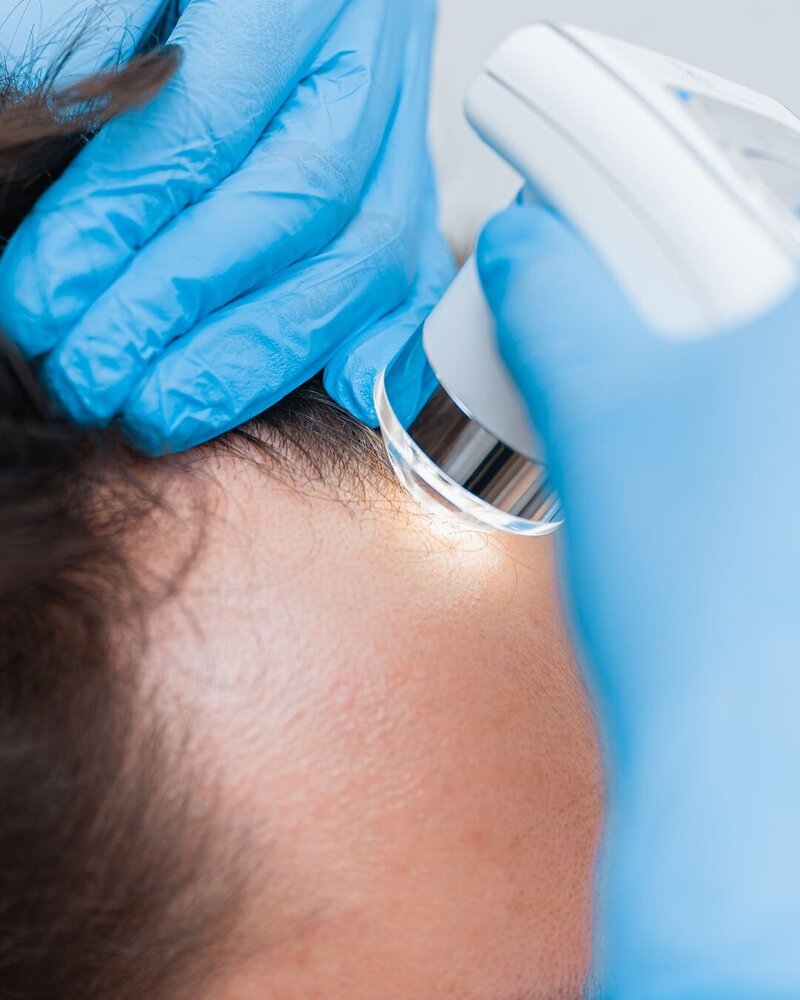 Close-up of woman receiving trichology treatment using a trichoscope