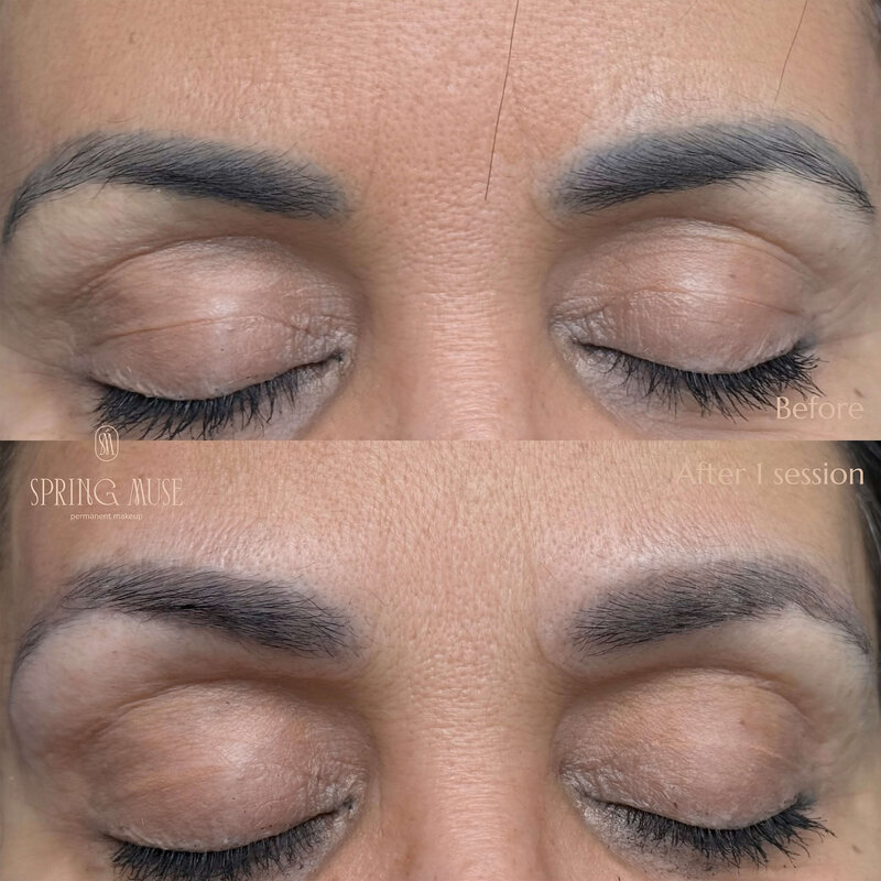 Laser Eyebrows Removal New York