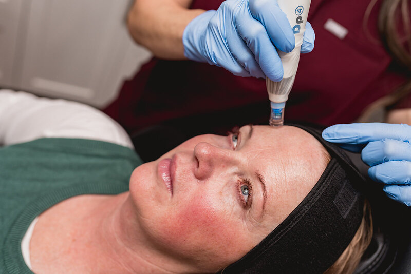 Micro-needling facial and Vampire Facials for anti-aging