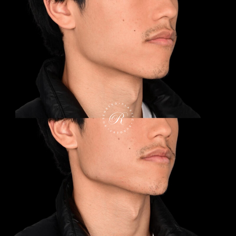 Non-surgical ChinJaw Augmentation RPS Before & After.zip - 46
