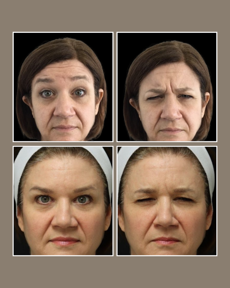 Injectables - Glösense Dermatology and Aesthetics, Miami