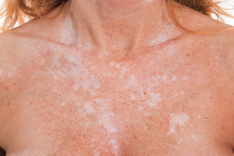 close up of woman's chest and neck area with skin discolorations