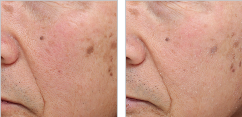 Before and after ClearSilk™ laser treatment for redness and pigmentation correction.