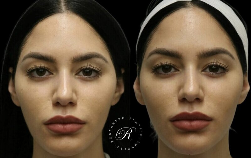 Non-surgical ChinJaw Augmentation RPS Before & After.zip - 4