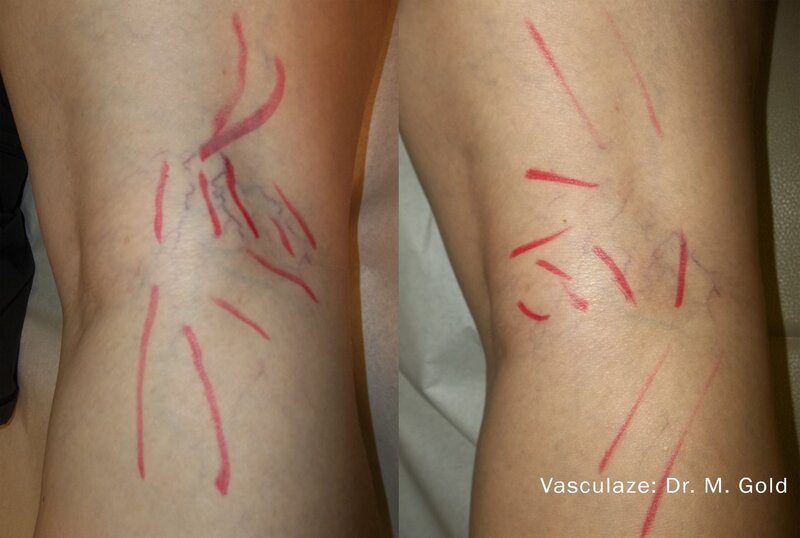 vasculaze-before-after-dr-m-gold-preview-1