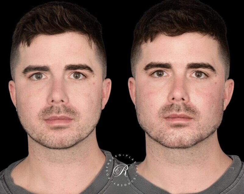 Non-surgical ChinJaw Augmentation RPS Before & After.zip - 26