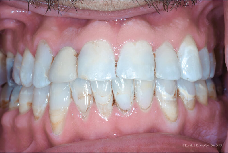 Example 1- a close up shot of the teeth  after VENEERS & CROWNS