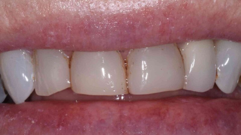 Example 3-a Photo of a patient Before getting the Zoom Whitening treatment with staining on the teeth
