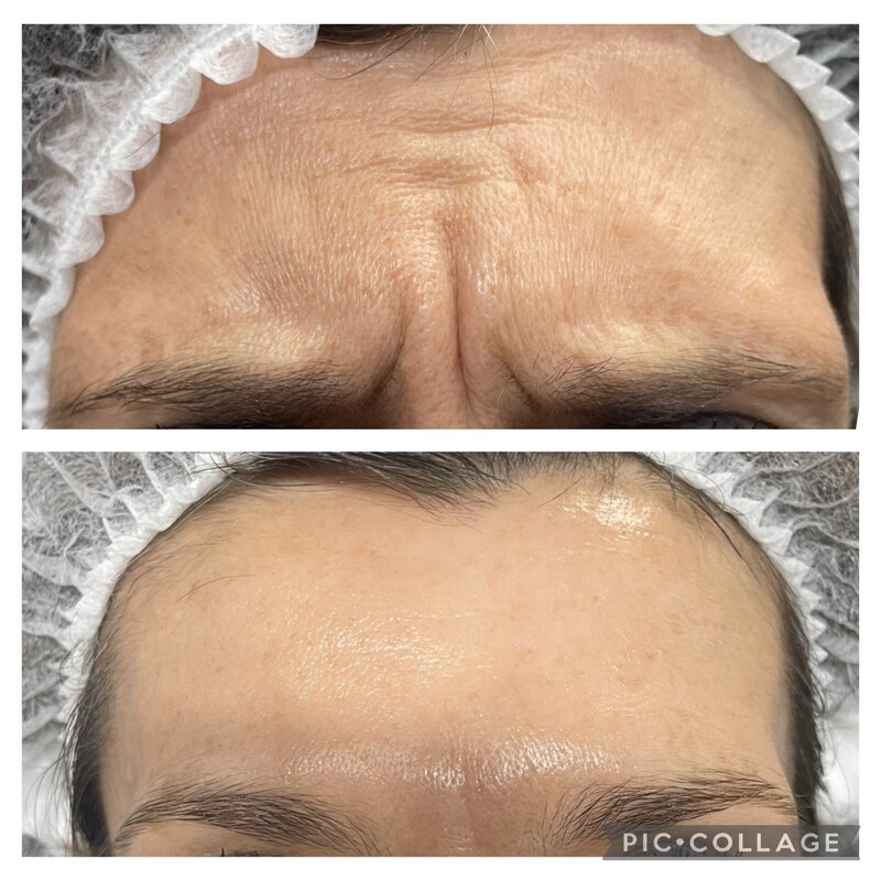 anti wrinkle injections norwich norfolk