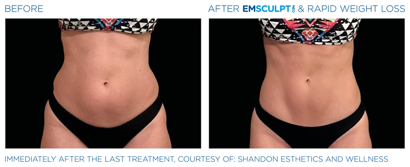 Emsculpt_Neo-Weight-Loss_PIC_Ba-card-female-abdomen-007_ENUS100