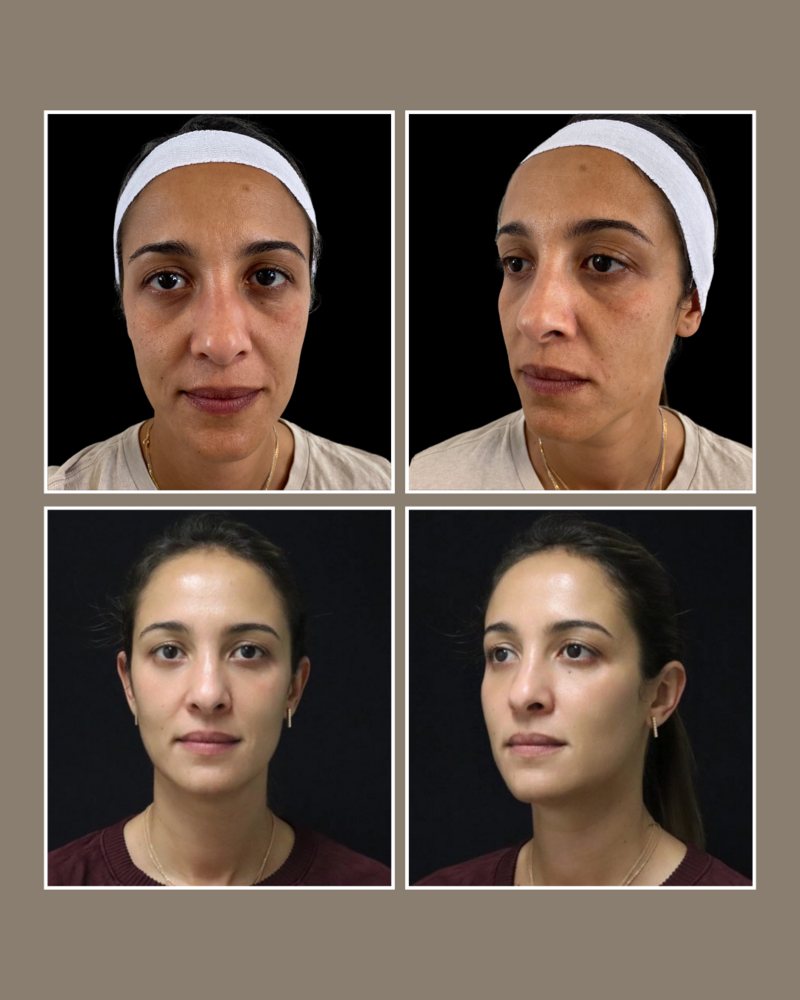 facial harmonization - Injectables - Glösense Dermatology and Aesthetics, Miami