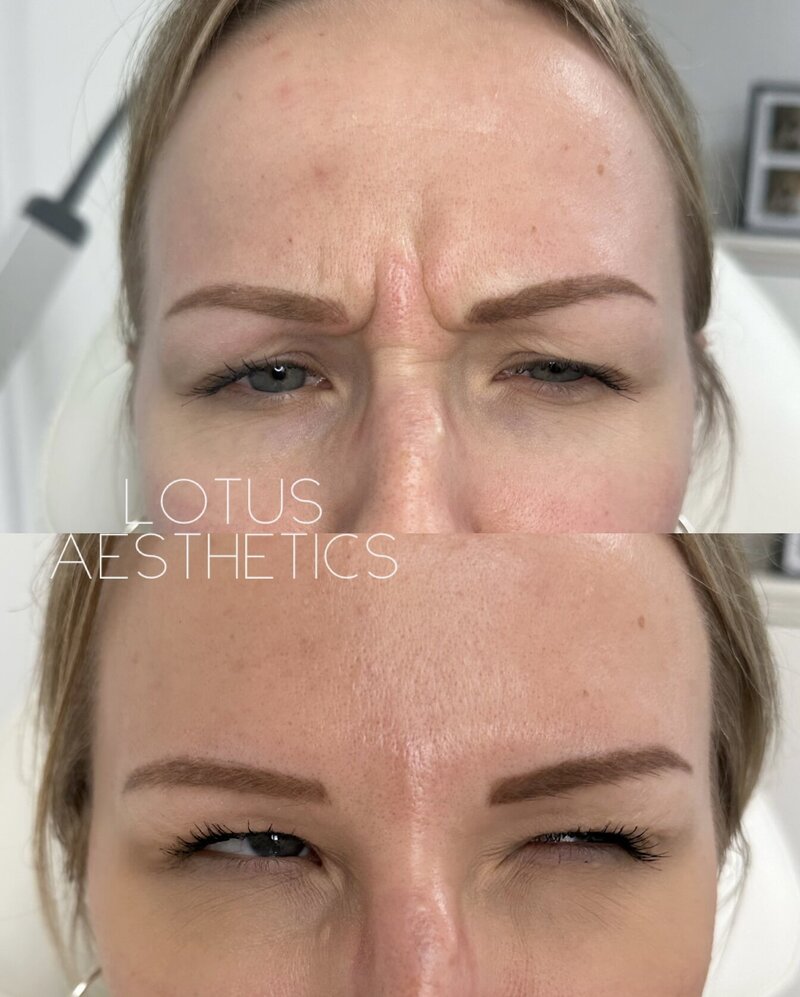 glabella botox