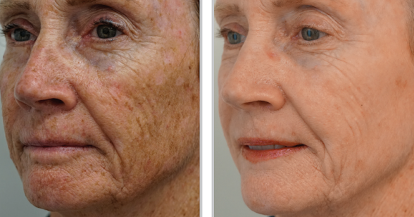Side-by-side results of BBL® HEROic™ treatment showing minimized hyperpigmentation and an even skin tone.