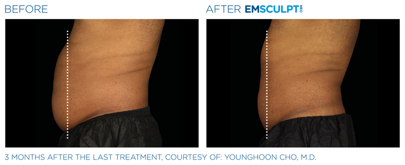 Emsculpt_Neo_PIC_Ba-card-male-lateral-abdomen-148_ENUS100