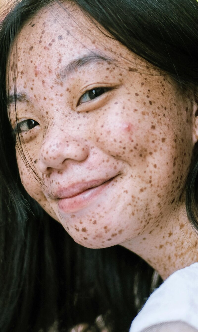 Woman with acne smiling