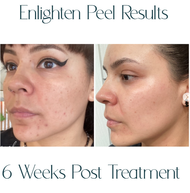 Enlighten Peel Results