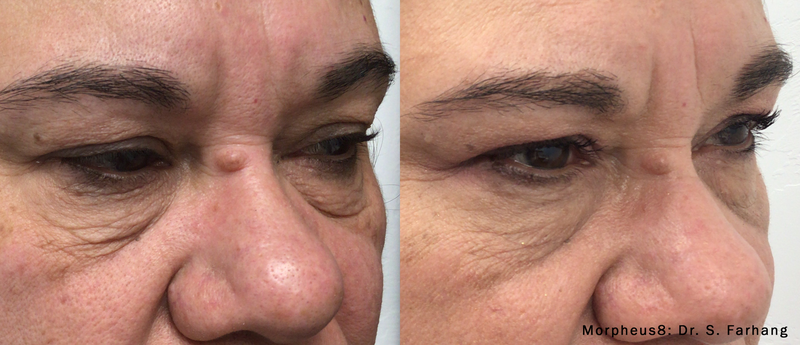 morpheus8-before-after-dr-s-farhang-preview-1