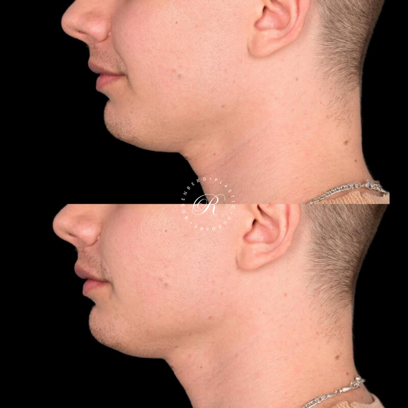 Non-surgical Lip Augmentation RPS Before & Afters.zip - 17