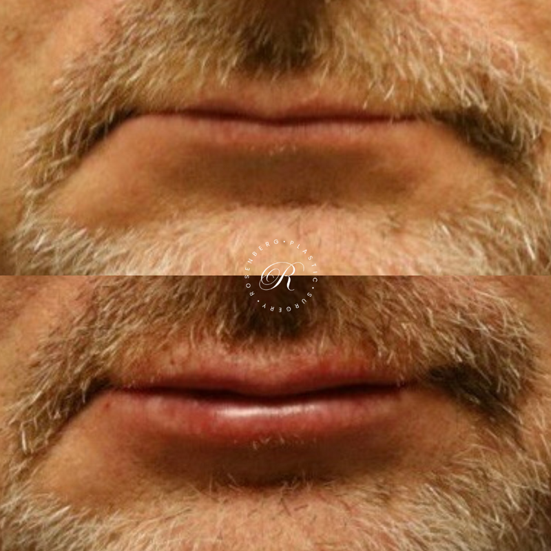 Non-surgical Lip Augmentation RPS Before & Afters.zip - 20