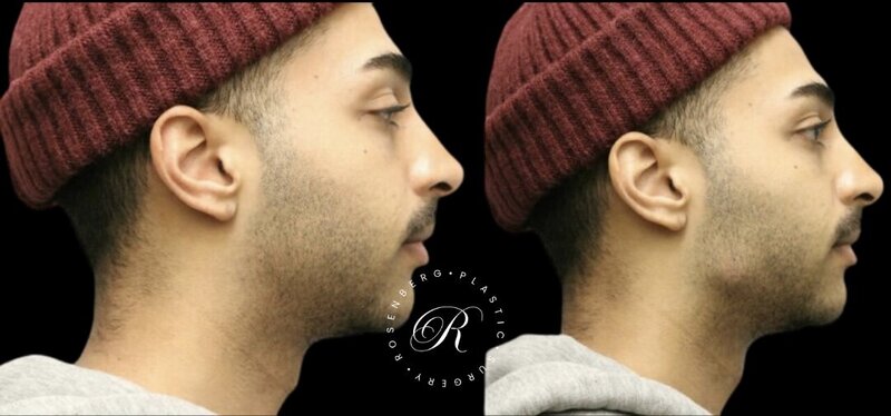 Non-surgical ChinJaw Augmentation RPS Before & After.zip - 12