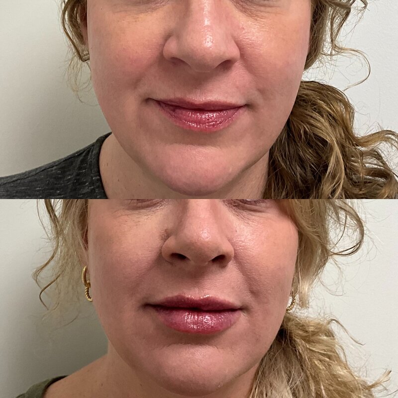 Before and after of lip injections performed at Refined Medical NY in East Setauket Long Island, showcasing enhanced lip volume and facial aesthetics.