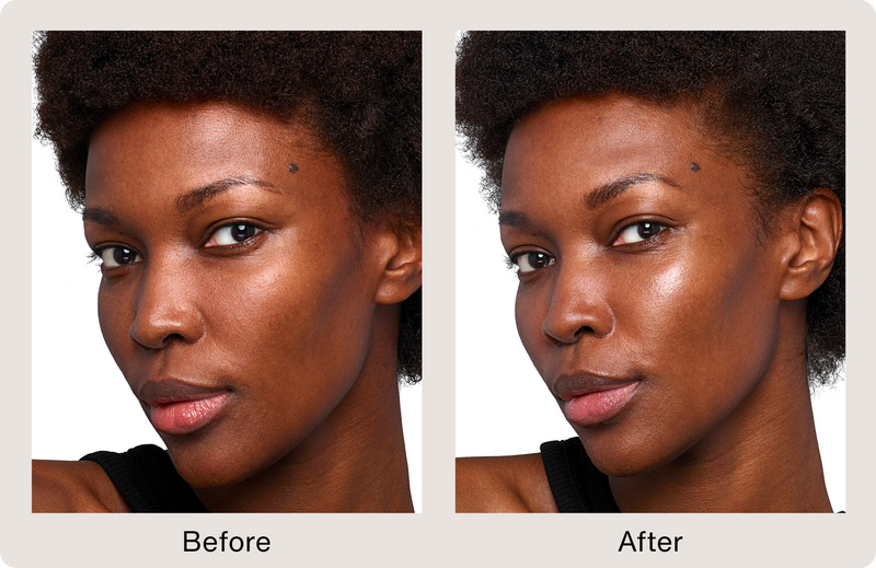 Before and after image comparison for a black woman using Juvederm dermal fillers.
