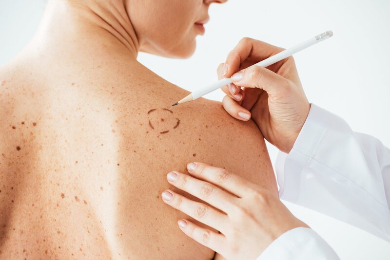 doctor marking margins around mole on woman's back