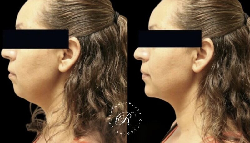 Non-surgical ChinJaw Augmentation RPS Before & After.zip - 33