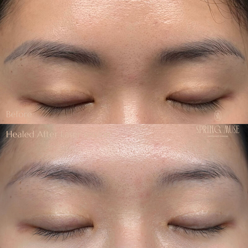 Laser Eyebrows Removal New York