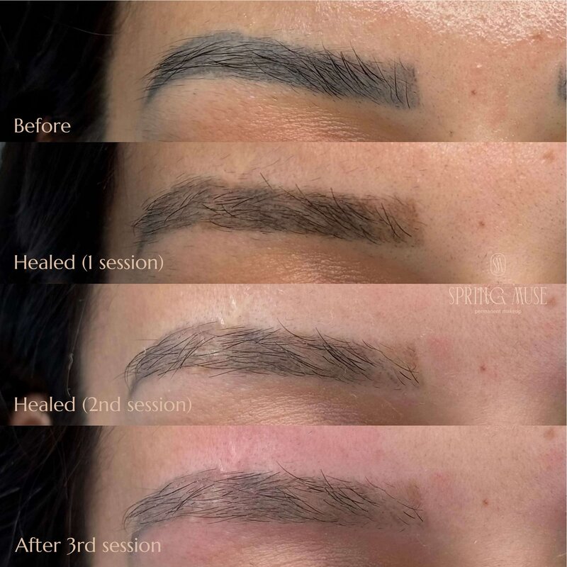 Laser microblading removal NYC