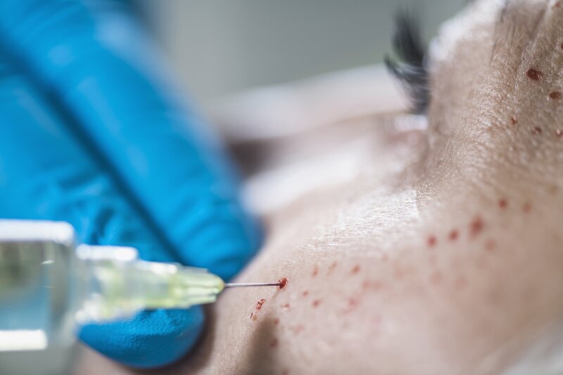 prp-face-cosmetics-injecting-cosmetic-anti-aging-2024-10-18-13-51-24-utc
