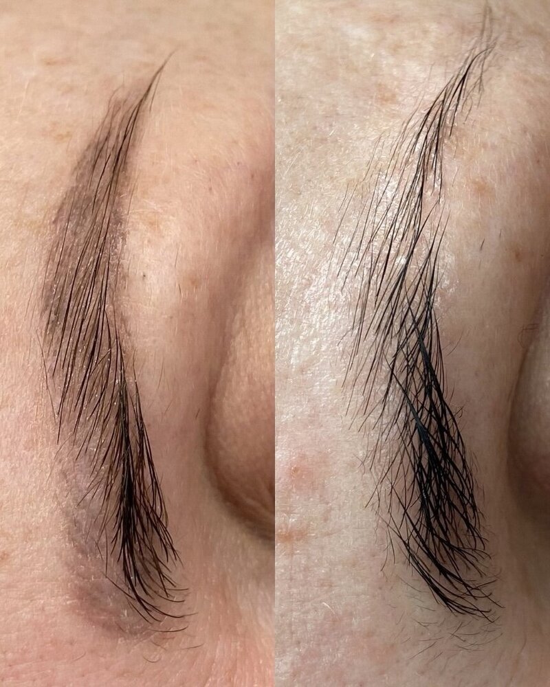 laser microblading removal nyc