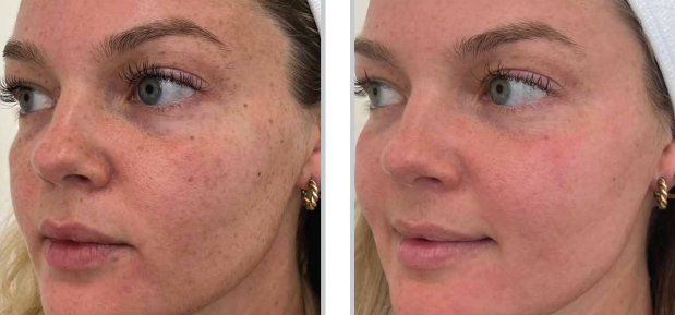 Before and after images of a BBL® HEROic™ broadband light laser treatment reducing hyperpigmentation, redness, and uneven skin texture.