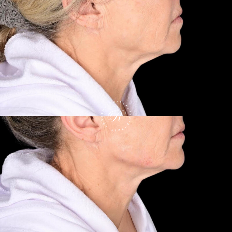 Non-surgical ChinJaw Augmentation RPS Before & After.zip - 53