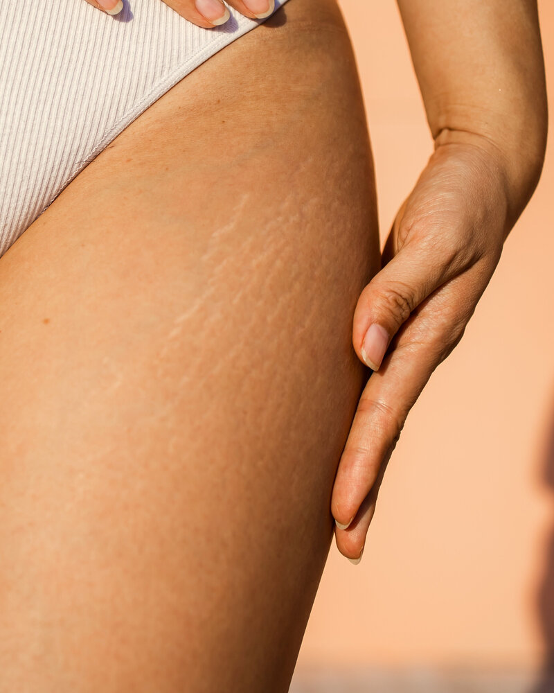 Vergetures du corps d'une femme avant une séance de dermopigmentation réparatrice