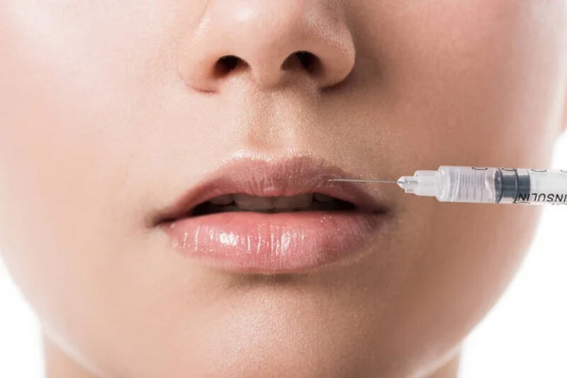 lip botox photo of injection