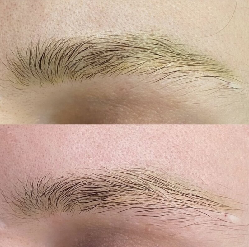 yellow microblading removal nyc